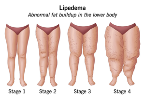 O lipedema, deve ser tratado o mais rápido possível, para evitar o seu agravamento
