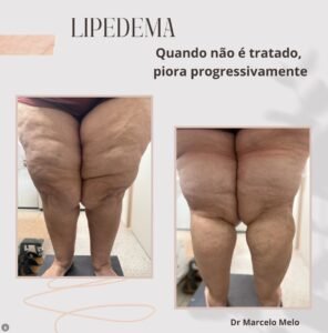 O Que é Lipedema? Entenda as Causas, Sintomas e Tratamentos O Que é Lipedema? Entenda as Causas, Sintomas e Tratamentos